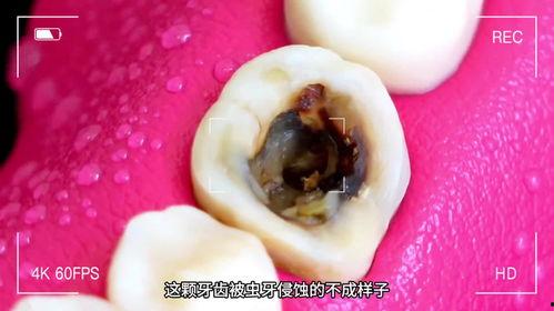 清理蛀牙视频,专业视频带你了解牙医操作细节